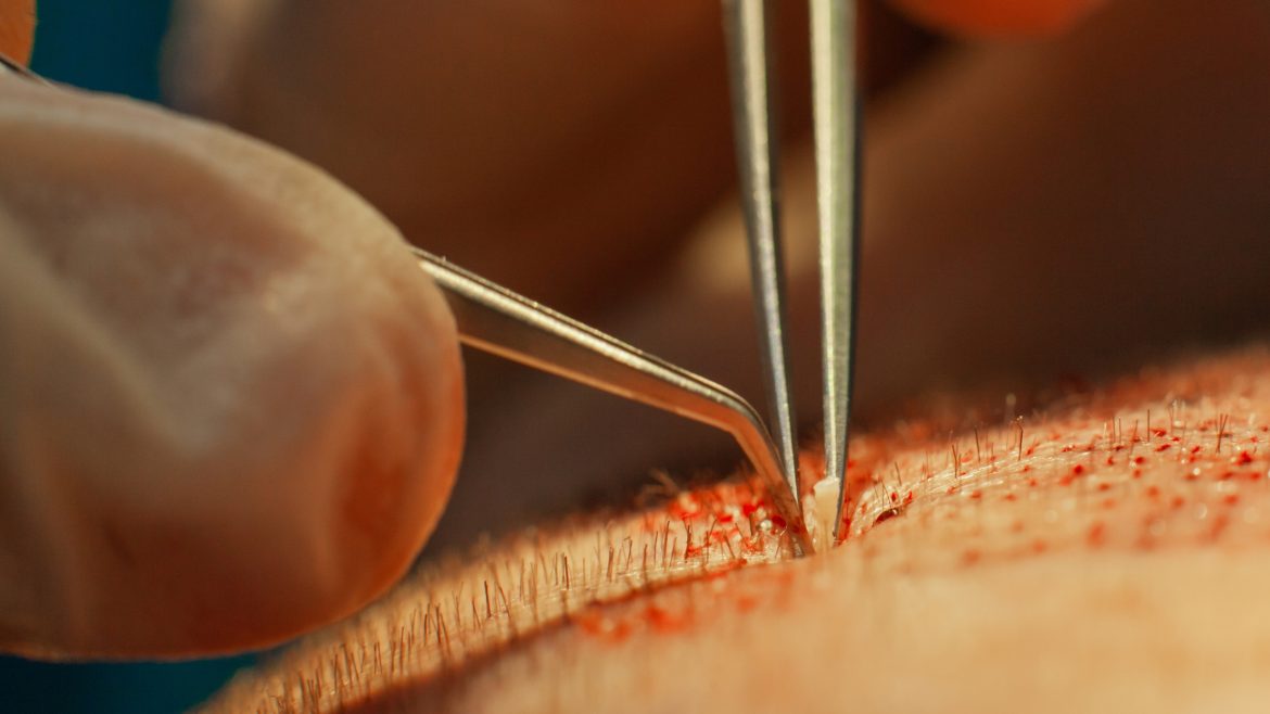 istanbul hair transplant