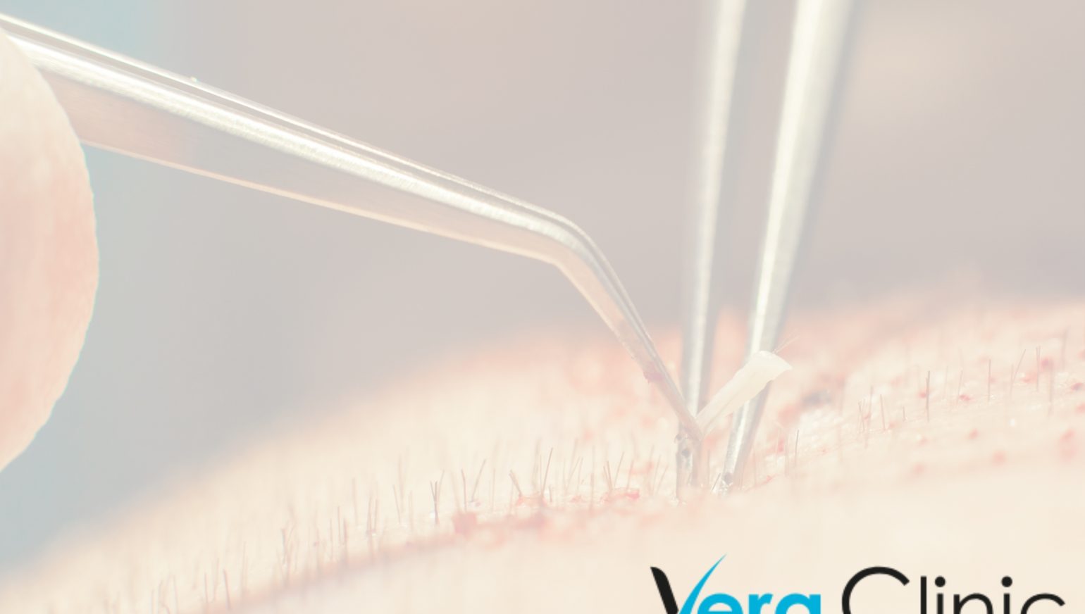 Ethical Practices And Transparent Pricing At The Best Hair Transplant Clinics In Istanbul
